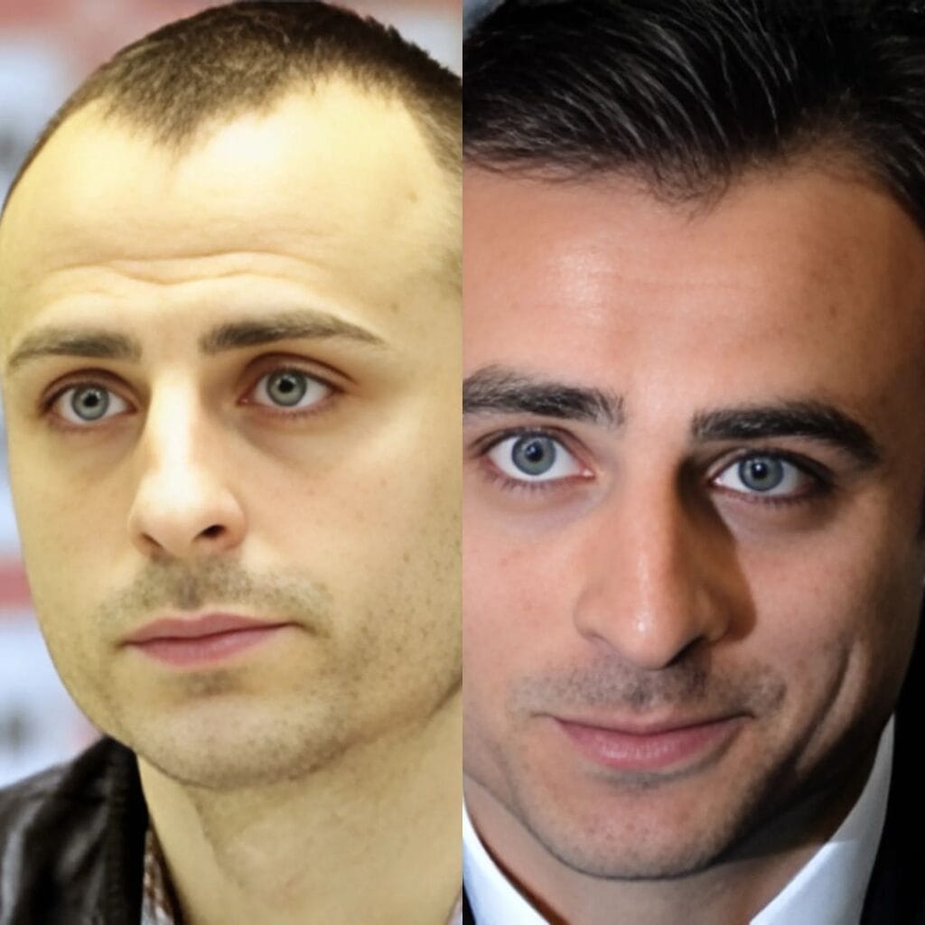 How did Dimitar Berbatov's public acknowledgment of his hair transplant affect others?