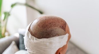 First Seven Days After Hair Transplant