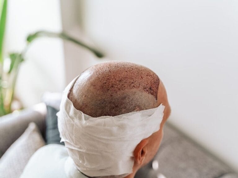 Pflegehinweise für die ersten 7 Tage nach der Haartransplantation in der Vivid Clinic