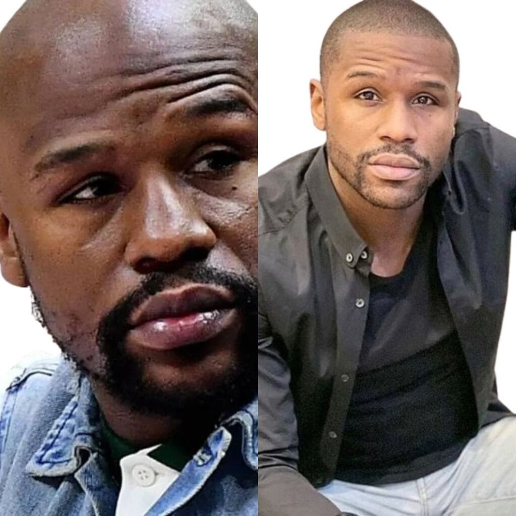 What type of hair transplant did Floyd Mayweather reportedly undergo?