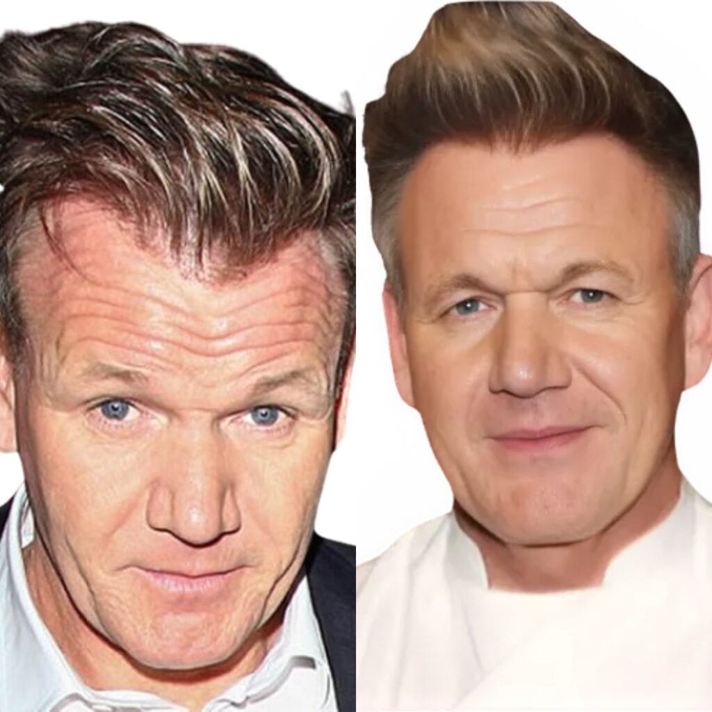 What type of hair transplant procedure did Gordon Ramsay reportedly have?