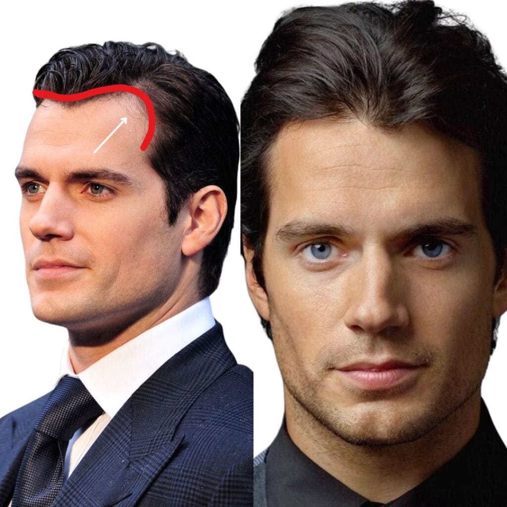 What might be preventing Henry Cavill from considering a hair transplant?