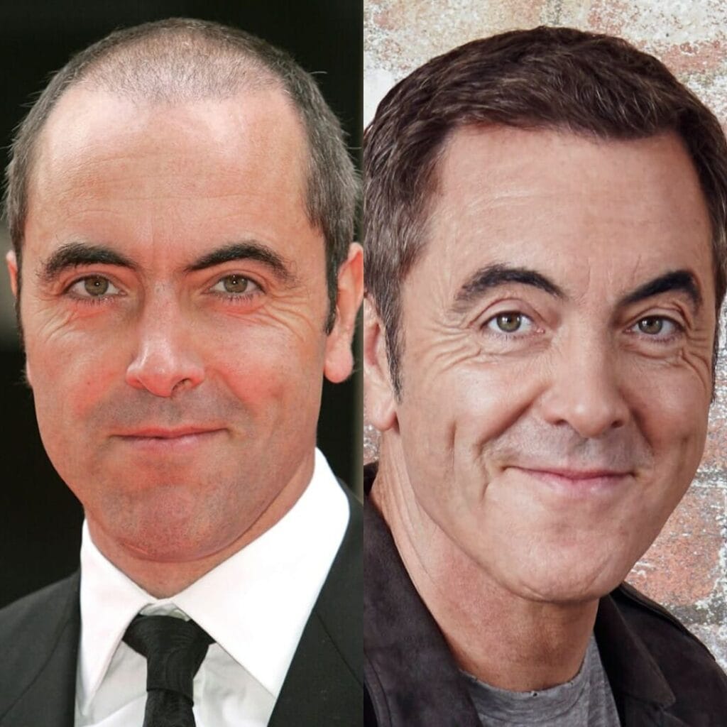 What admissions has James Nesbitt made about his hair transplant experiences?