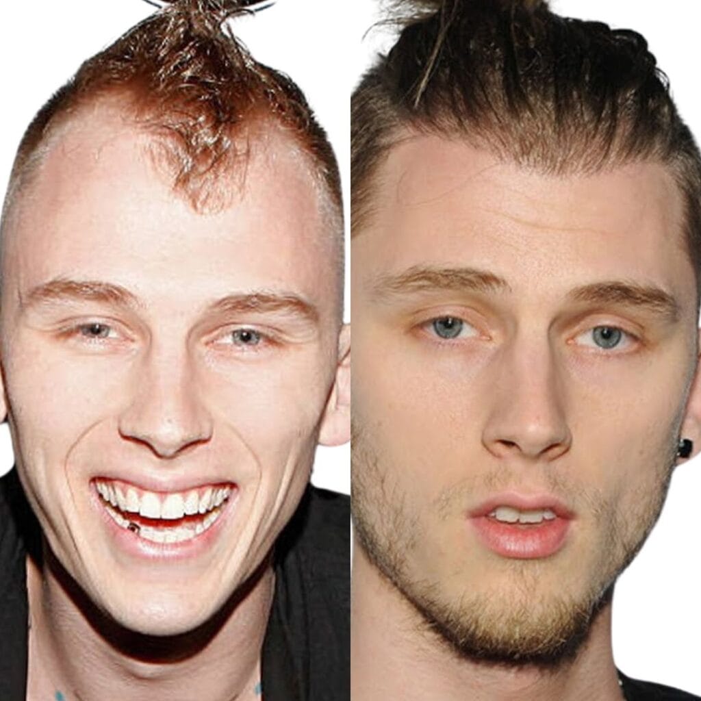 How many grafts are estimated to have been used in Machine Gun Kelly's hair transplant?