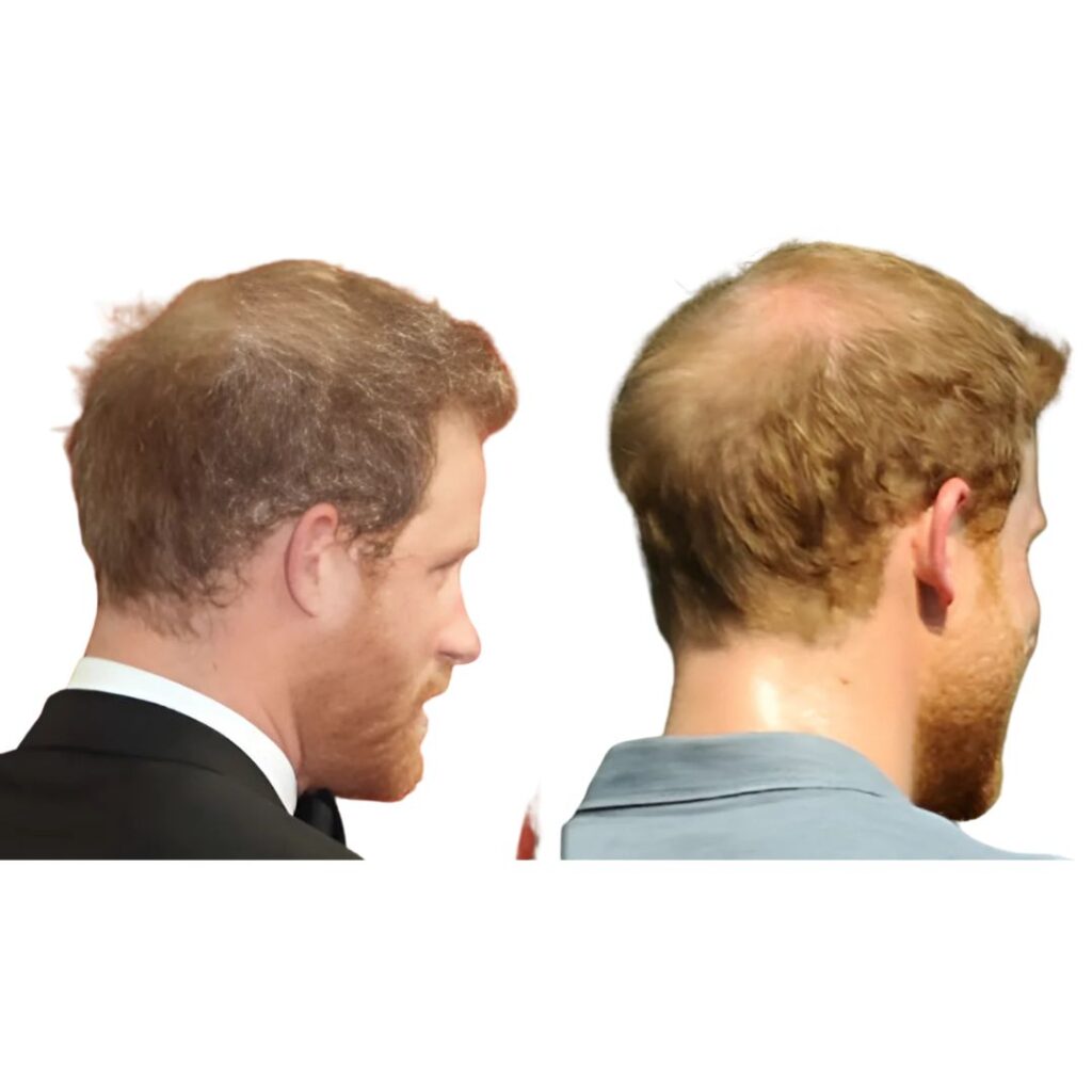 Has Prince Harry undergone a hair transplant procedure?