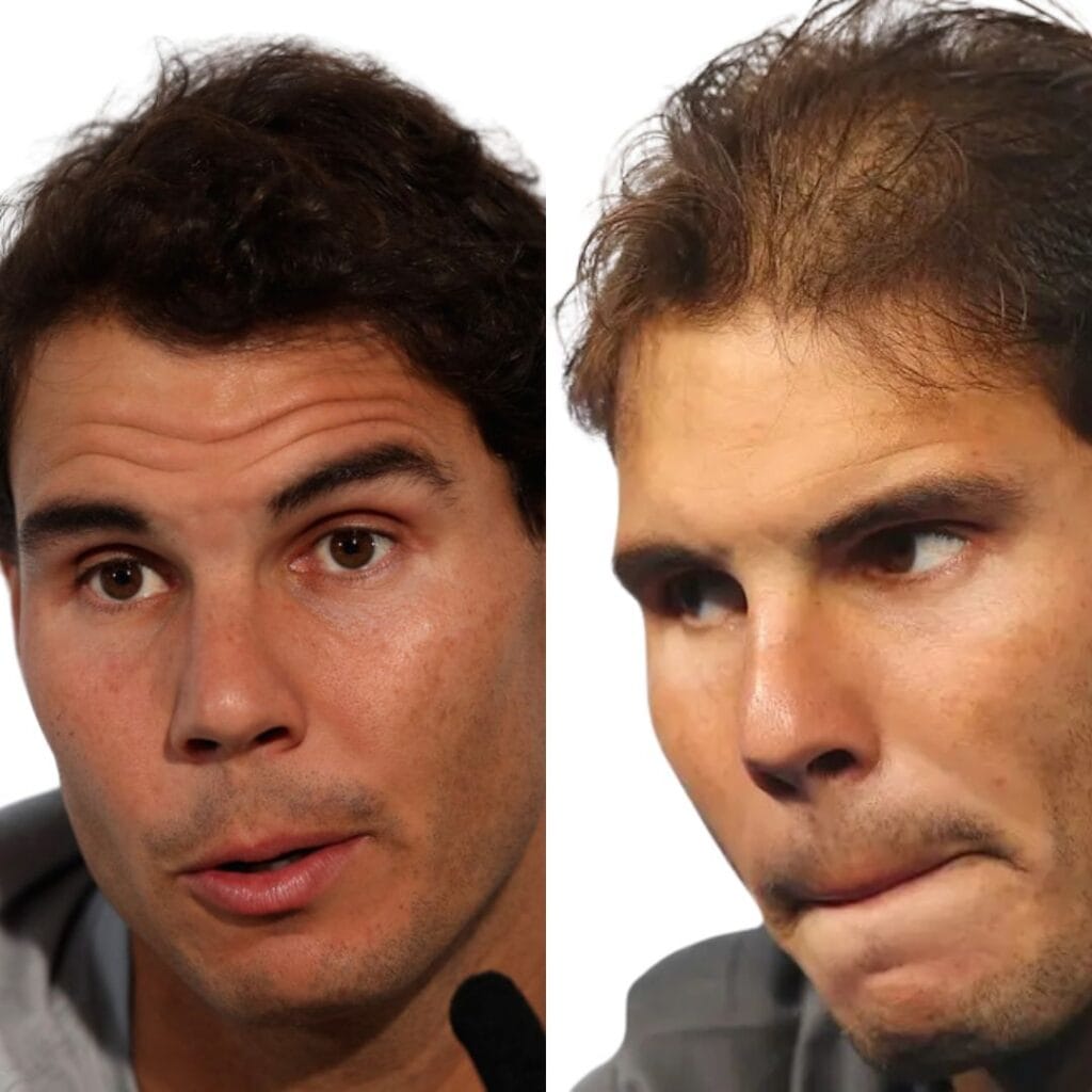 How Successful Was Rafael Nadal's Celebrity hair transplants Procedure?