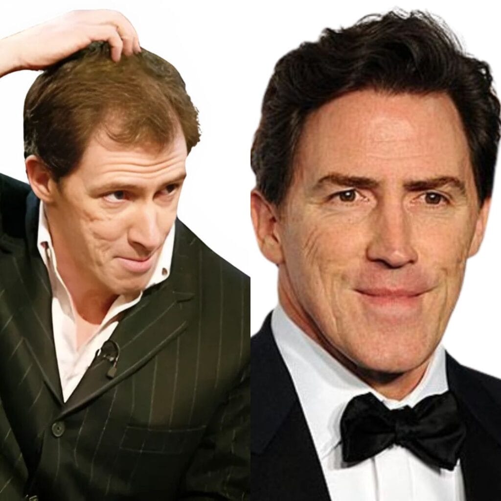 What changes were noticeable in Rob Brydon's appearance after his alleged hair transplant?