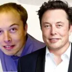 Elon Musk before and after hair transplant comparison.