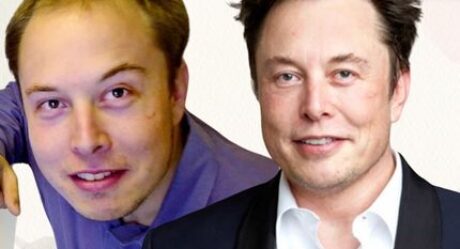 El proceso de trasplante de pelo por el que pasó Elon Musk