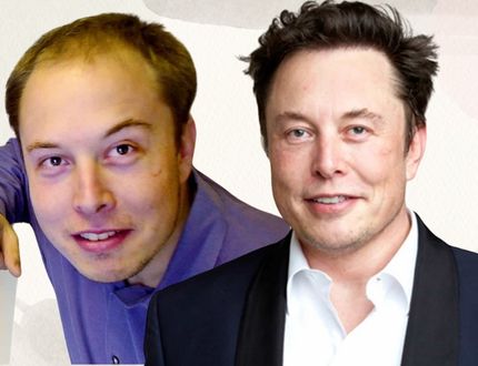 Elon Musk before and after hair transplant comparison.