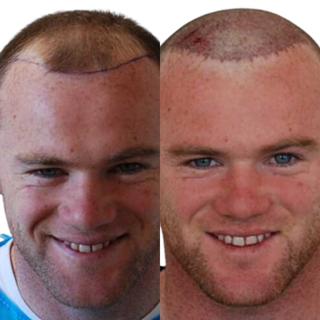 Wayne Rooney before and after his openly admitted hair transplant.