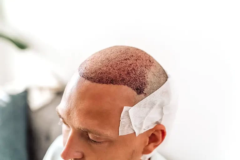 مقارنة تكلفة زراعة الشعر في عيادة Vivid في اسطنبول.