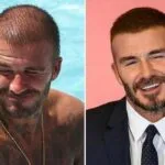 Celebrity undergoing hair transplant at Vivid Clinic.