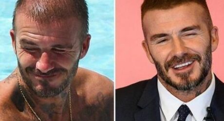 عمليات زراعة شعر المشاهير: 7 مشاهير من الذين استعادوا خط شعرهم