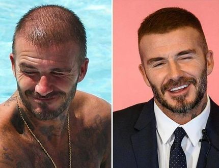 Celebrity Hair Transplants: 7 Famous Actors Who Restored Their Hairline