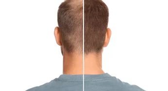 How Much Does a Hair Transplant Cost in Istanbul?