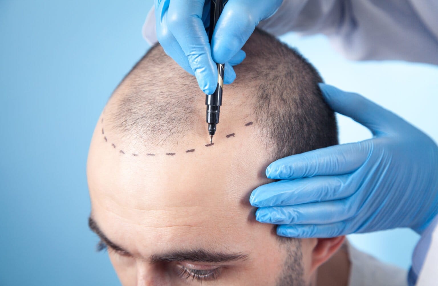 Close-up van de directe haarimplantatieprocedure met behulp van de Choi Implanter Pen.
