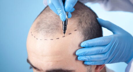 زراعة الشعر بزراعة الشعر المباشرة: الإجراءات والفوائد