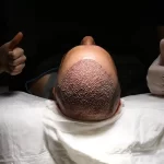 Hair Transplant cost comparison between Turkey and other countries at Vivid Clinic