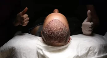 Hair Transplant Cost Comparison: Turkey vs. Other Countries