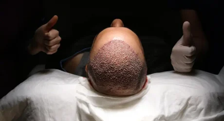 Global Hair Transplant Cost Comparison (2025): Why Turkey Remains #1