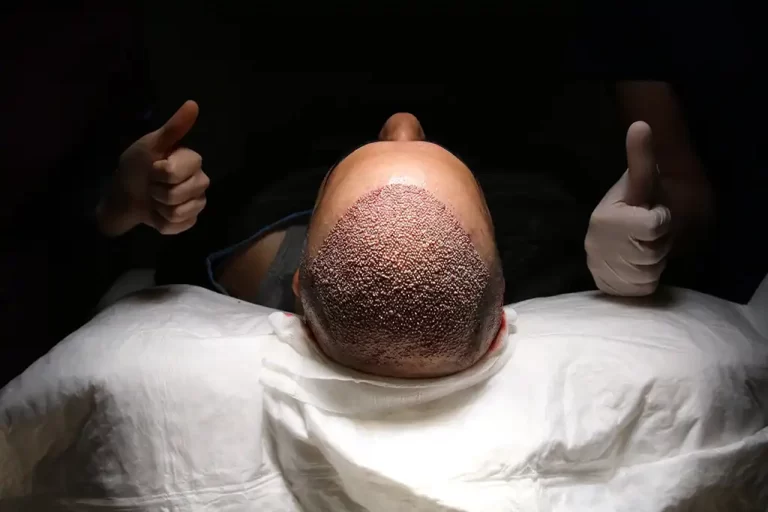 FUE Hair Transplant Procedure Steps