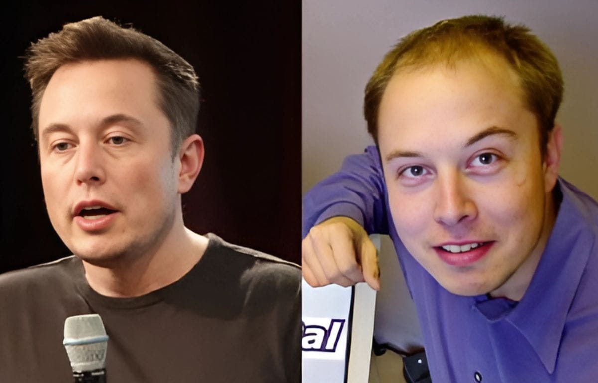 Elon Musk before and after his hair transplant showing a significant improvement in hair density.