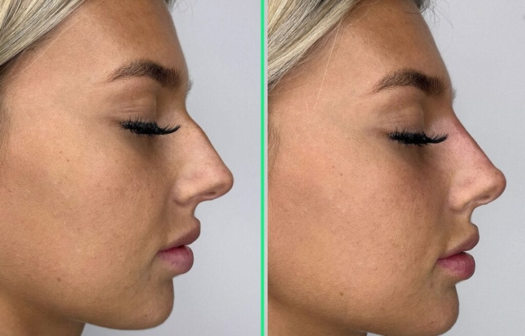 Before and after open rhinoplasty at Vivid Clinic showing a narrower nasal bridge and refined nostrils.