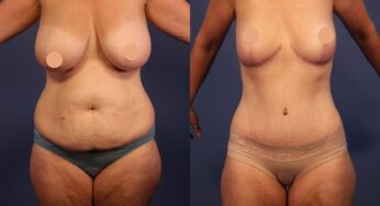 Liposuction Recovery in Istanbul: 5 Key Steps for a Smooth Healing Process