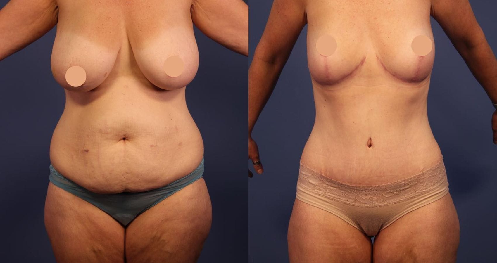 Before and after liposuction showing a patient with a slimmer waistline at Vivid Clinic