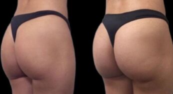 BBL in Turkey: Achieve Your Dream Curves with Brazilian Butt Lift Surgery