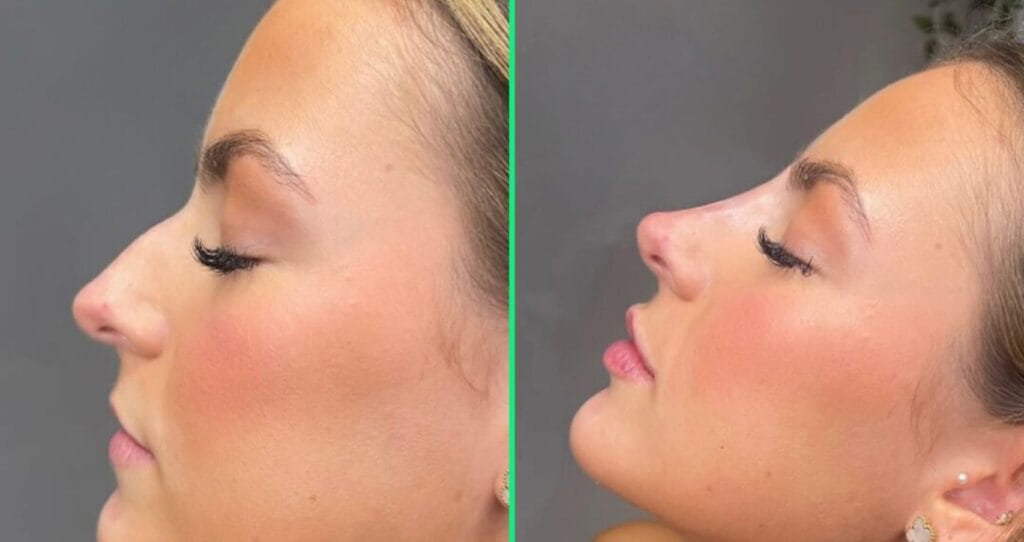 Best rhinoplasty surgeons in Istanbul providing top-tier results and exceptional care at Vivid Clinic.

