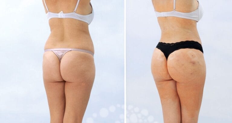 Brazilian butt lift result showing waist and buttock contour