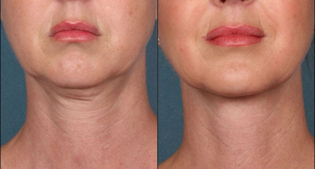 Neck Lift Before and After Results : Woman with visible signs of aging in the neck, including sagging skin and wrinkles.