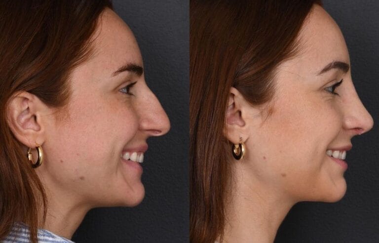 Side-by-side profile views used to compare cosmetic surgery results