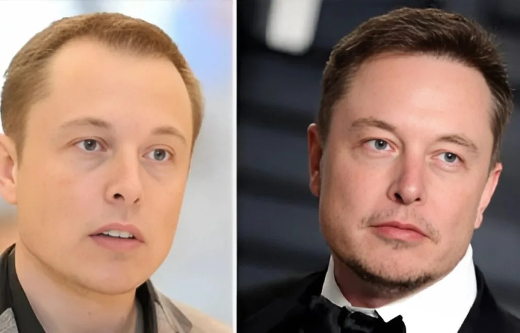 Doctor consulting with a patient before hair transplant surgery, similar to Elon Musk’s procedure.