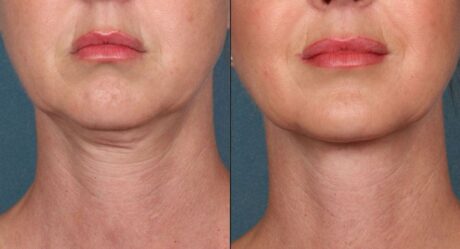 Transform Your Profile: Dramatic Neck Lift Before and After Results