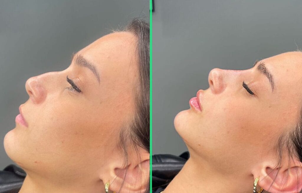 Before and after rhinoplasty at Vivid Clinic with a lifted nasal tip and improved nose symmetry