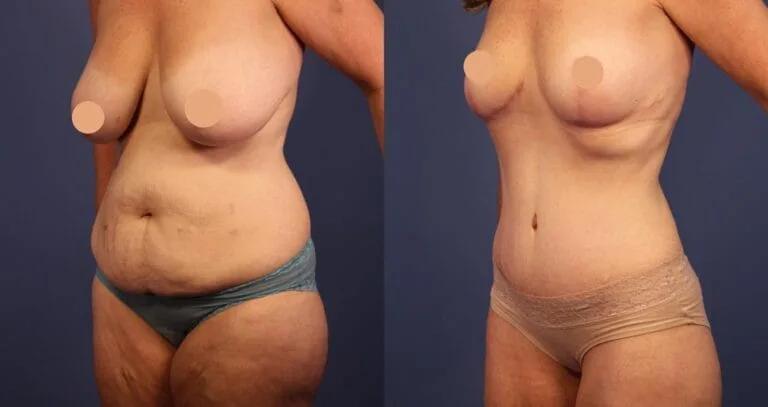 Vorher-nachher-Bilder einer Fettabsaugung zeigen die verbesserte Oberschenkelkontur einer Patientin in der Vivid Clinic.