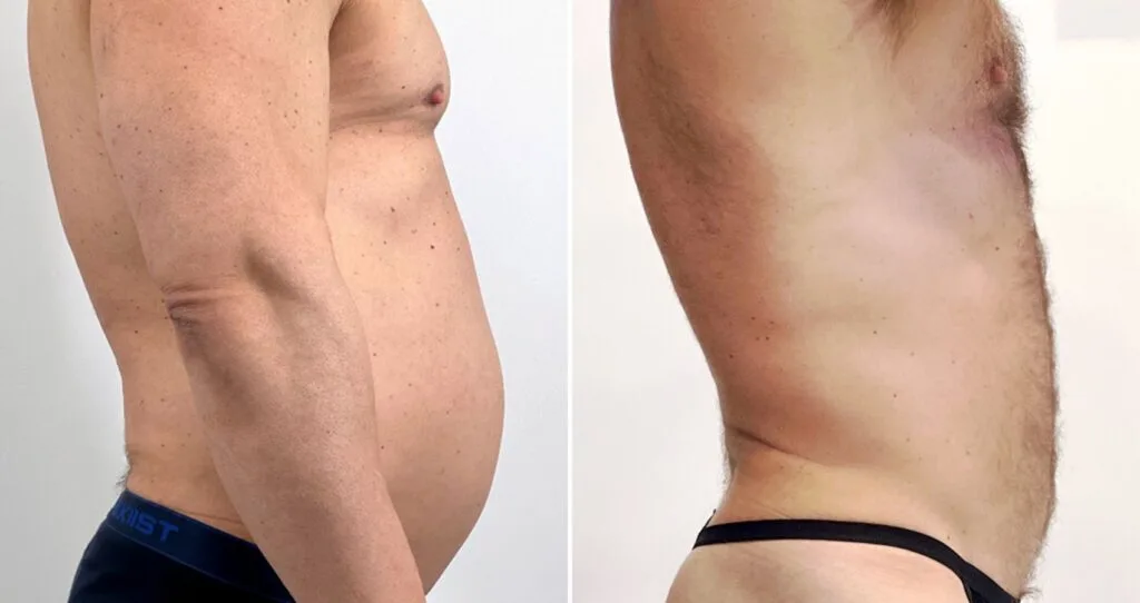 Best cosmetic surgery clinics in Istanbul showing before and after liposuction at Vivid Clinic