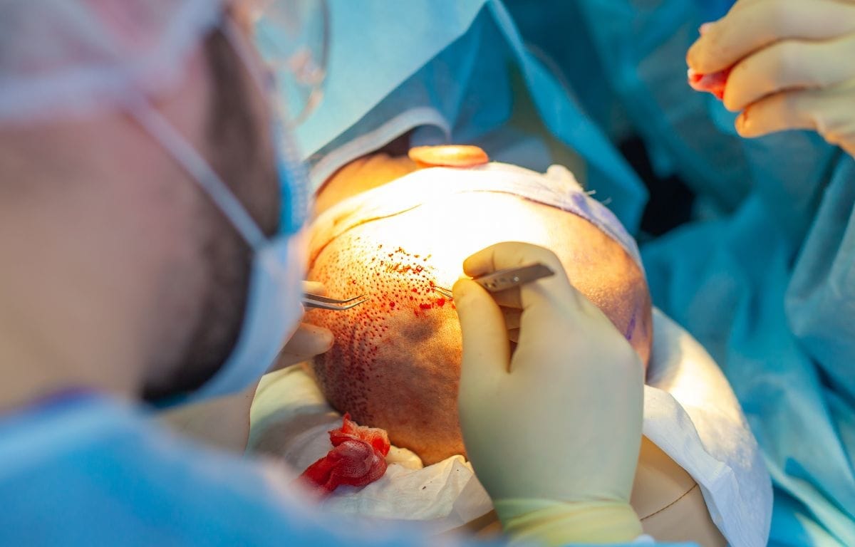 DHI-Haartransplantation: 8 wichtige Erkenntnisse vor Ihrer Transformation DHI-Haartransplantation – Patientenergebnisse der Vivid Clinic Istanbul