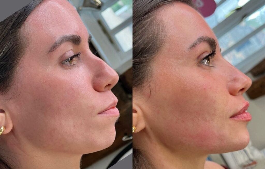 Before and after rhinoplasty results showing a reshaped nose.