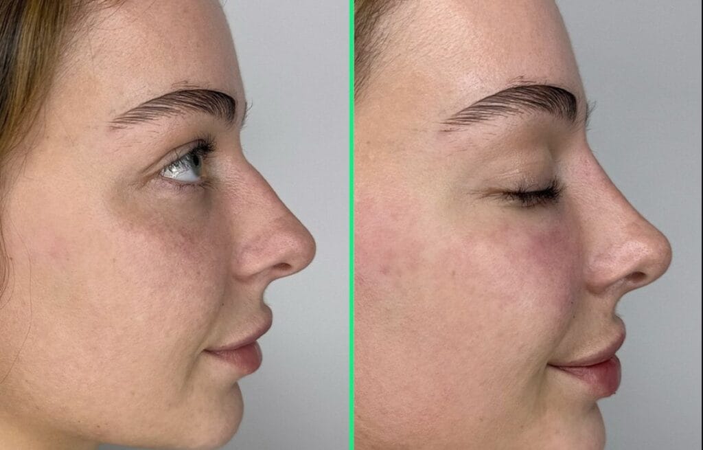 Before and after closed rhinoplasty at Vivid Clinic showing refined nasal tip and smooth bridge.