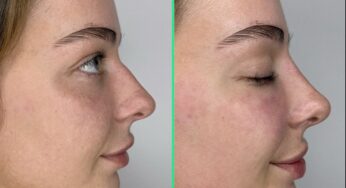 Rhinoplasty Cost in Turkey: 5 Incredible Benefits You Need to Know