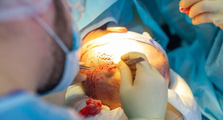 أطباء معتمدون من المشاهير لزراعة الشعر: أفضل الجراحين للحصول على نتائج طبيعية