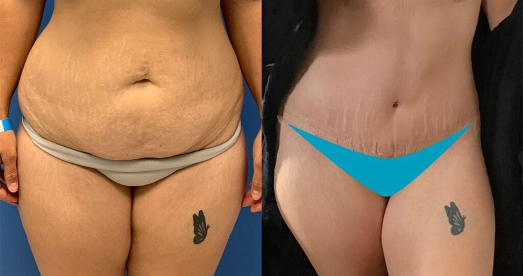 Patient’s before and after liposuction results showing a more toned abdomen after the procedure at Vivid Clinic.