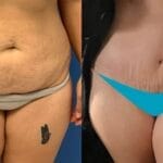 Costo del rimodellamento del corpo in Turchia: 8 fattori concreti che influenzano il prezzo Risultati della liposuzione prima e dopo il trattamento presso la Vivid Clinic: l'addome risulta più tonico.
