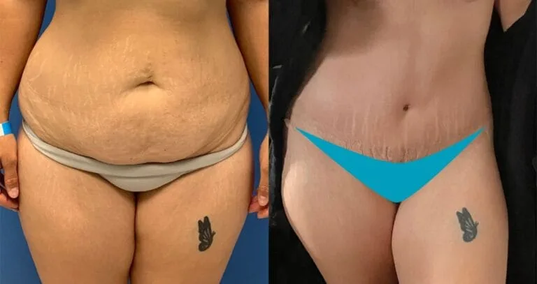 Die Ergebnisse der Patientin vor und nach der Fettabsaugung zeigen einen strafferen Bauch nach dem Eingriff in der Vivid Clinic.