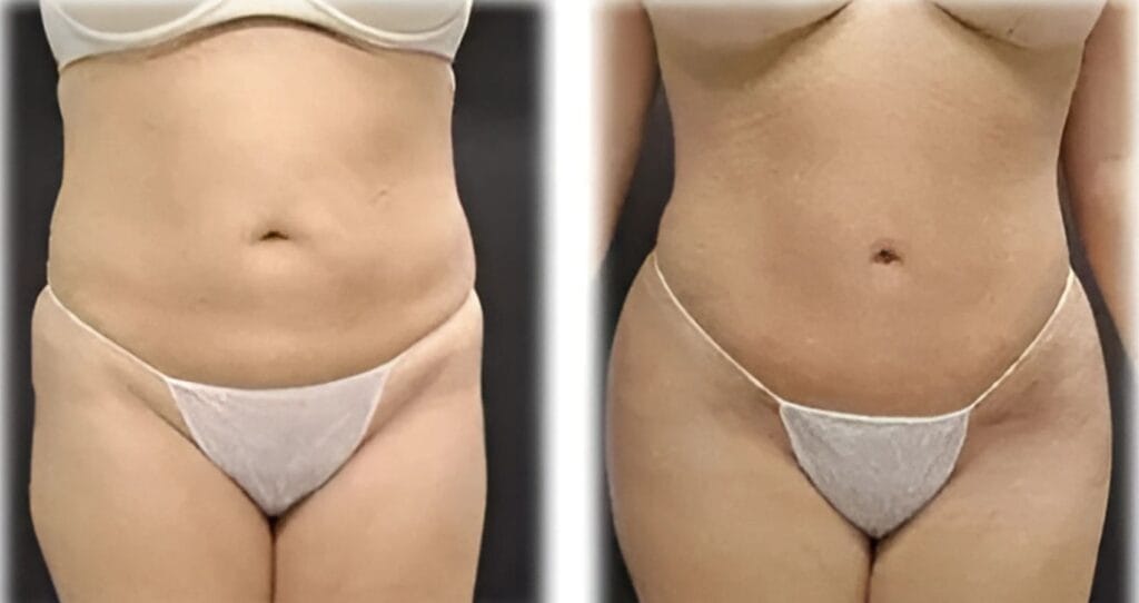 Best cosmetic surgery clinics in Istanbul showing before and after liposuction at Vivid Clinic