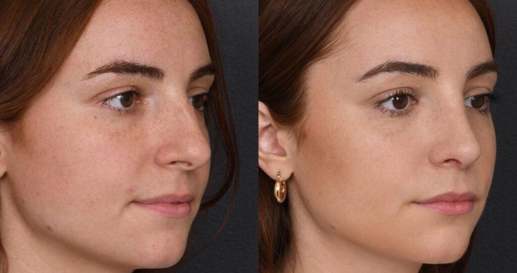 Best rhinoplasty surgeons in Istanbul offering high-quality, natural-looking nose reshaping procedures with affordable prices and top-tier results at Vivid Clinic.